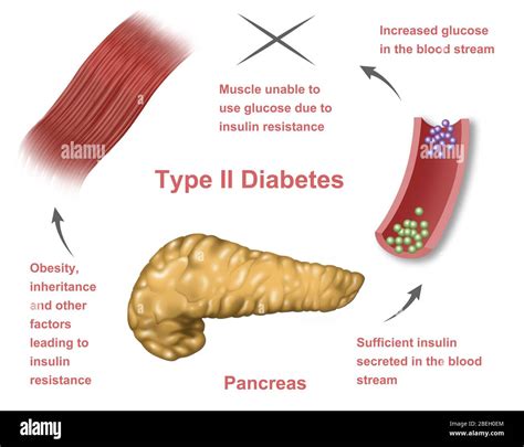 Diabetes Mellitus Type Schematic Diagram Diabetes Type Mellitus