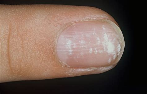 Leukonychia Causes Symptoms Leukonychia Treatment For
