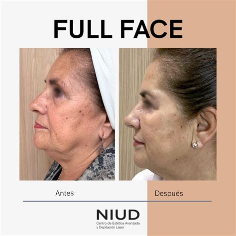 Full Face Tratamiento De Rejuvenecimiento Facial Sin Cirug A Niud