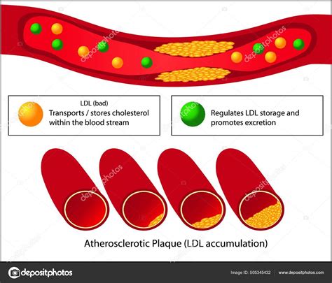 Role Good Bad Lipids Levels Atherosclerotic Plaque Blood Vessel Medical