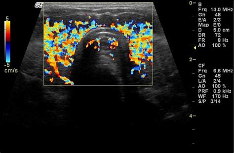 Thyroid Ultrasound Top 10 Pathology 9 Graves Disease