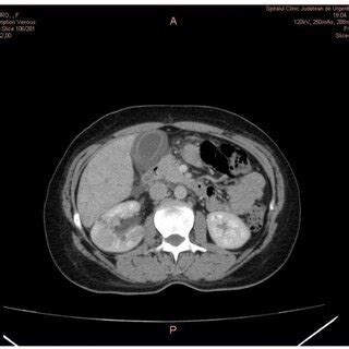 Contrast-enhanced CT scan of a patient in the venous phase showing... | Download Scientific Diagram