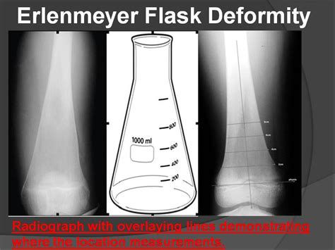 Erlenmeyer Flask Deformity Radiology Classroom