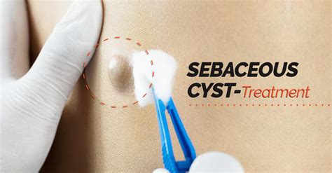 Sebaceous Cyst Treatments