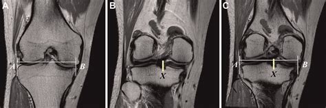 Figure 2 From Does Medial Meniscal Allograft Transplantation With The