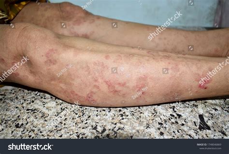 Psoriasis Fungal Infection Called Tinea Corporis Foto Stock 1748046869