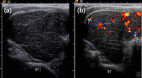 Hashimotos Thyroiditis Ultrasound