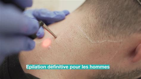 Epilation Laser Homme Nuque Youtube