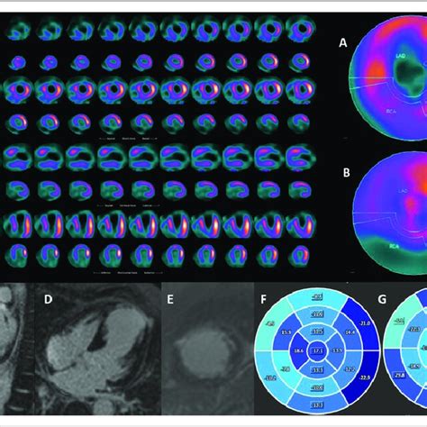 Myocardial Viability Evaluation By Nuclear Medicine Imaging Spect And