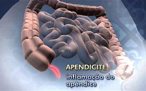 Mais Você Cirurgia de apêndice Globoplay