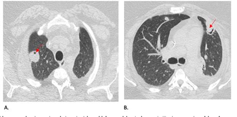 Figure 1 From Staphylococcus Aureus Native Mitral Valve Endocarditis Associated With Bed Bug