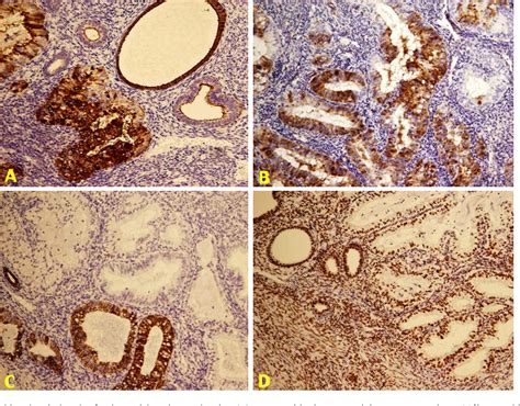 Figure 2 From Pseudomyxoma Peritonei With Endometrial Mucinous