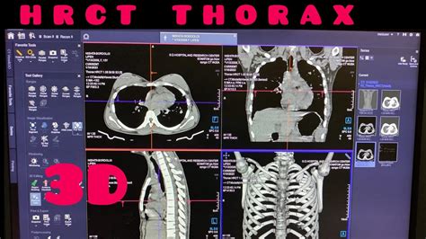 Hrct Thorax D Filiming Full Processing Youtube