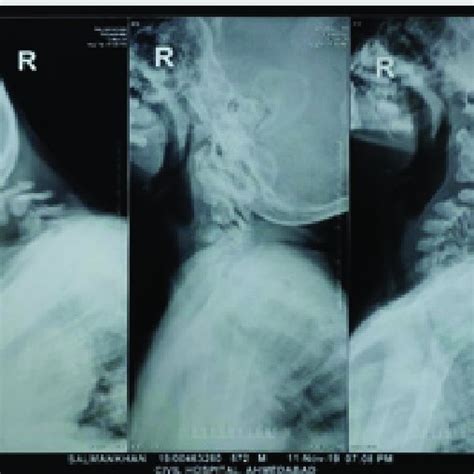 Pre Operative Radiographs In Anteroposterior Lateral Projections Of