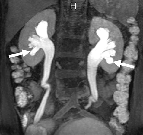 Mr Urography Techniques And Clinical Applications Radiographics