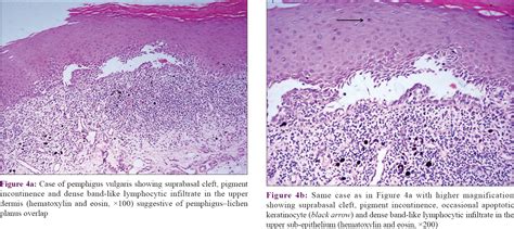 Clinical And Pathological Characterization Of Oral Mucosal Lichen