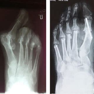 B Pre And Postoperative Anterior Posterior Radiological Picture Of