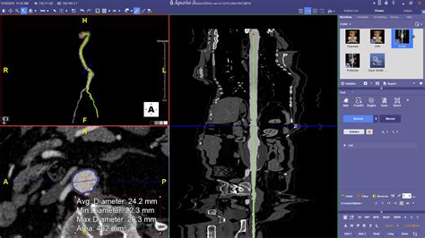 Interventional Radiology Package Terarecon