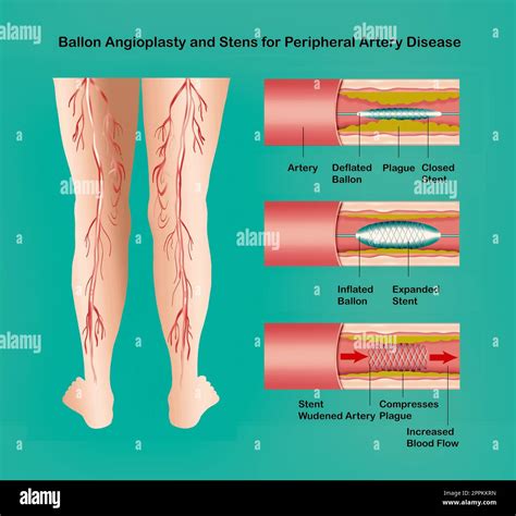 Diagrama Que Muestra La Angioplastia Para La Ilustraci N De La