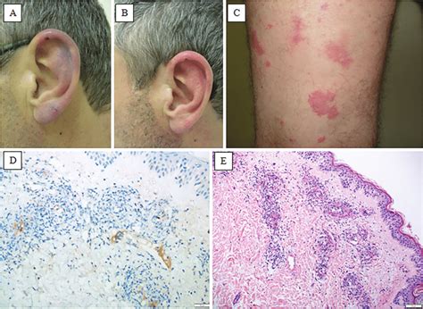 Skin lesions: A, Retiform purpura with a small area of necrosis in the ...