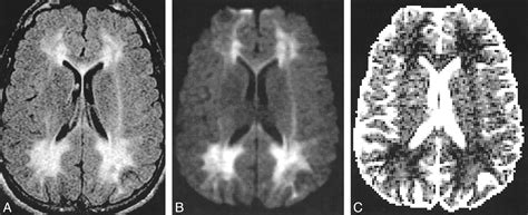 Phenylketonuria Brain