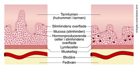 Coeliaki Villusatrofi Patienthåndbogen På Sundheddk