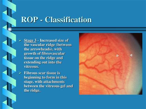 PPT Retinopathy Of Prematurity PowerPoint Presentation ID 4273995