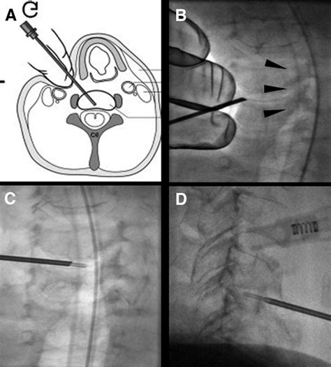 Anterolateral-approach technique with fluoroguidance. The left hand ...