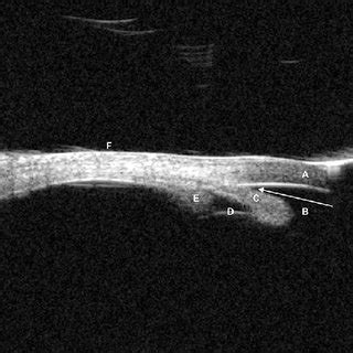 Ultrasound Biomicroscopy Of The Right Eye Showing Closed Angle At The