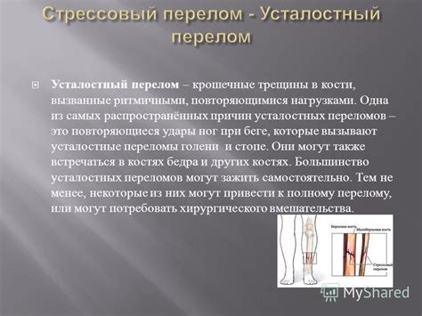 Презентация на тему: "« Стрессовый перелом или усталостный перелом ...