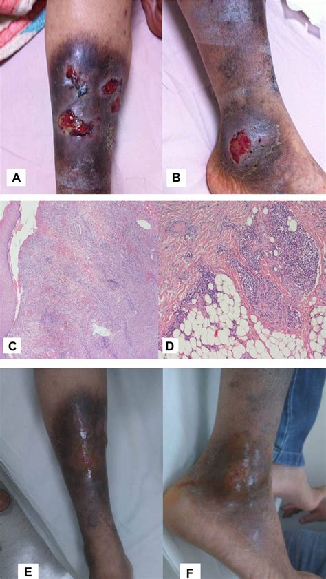 A Initial Picture Wound With Deep Ulcer And Some Necrotic Tissue