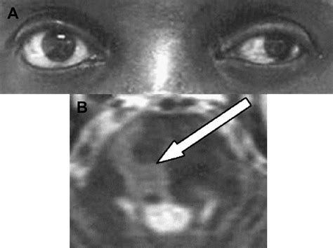 Eye Movement Abnormalities In Multiple Sclerosis Neurologic Clinics