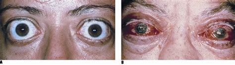 Thyroid Ophthalmopathy American Academy Of Ophthalmology