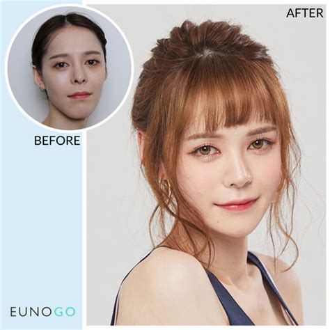 Top 10 Most Amazing Plastic Surgery Before & After Photos – Eunogo