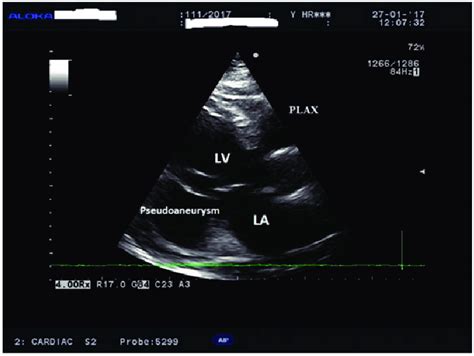 Parasternal Long Axis Plax View Showing A Pseudoaneurysm As A