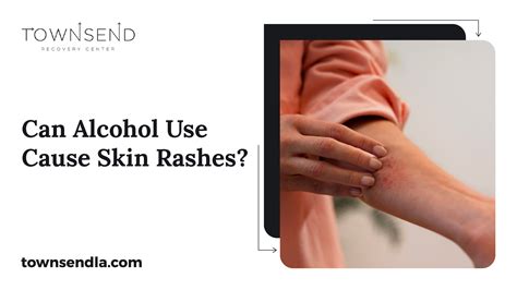 Can Alcohol Use Cause Skin Rashes