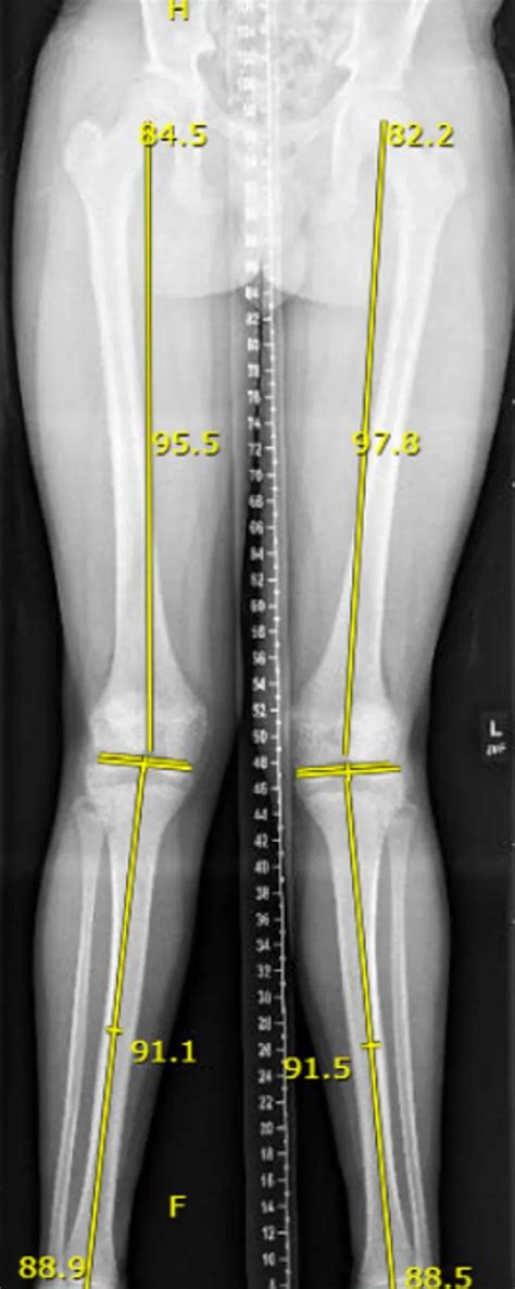 Treating Idiopathic Genu Valgum Knock Knees