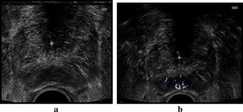 A Transrectal Ultrasound B Mode Image Shows The Loss Of Normal