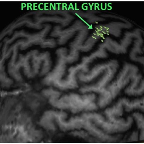 Navigated Transcranial Magnetic Stimulation Mapping Of The Cortical