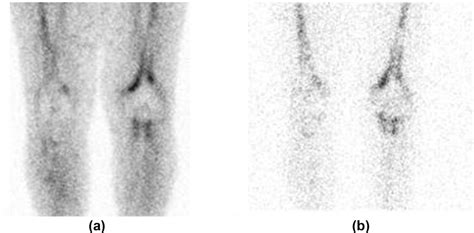 Aseptic Loosening Pattern Ii Aseptic Loosening Of Left Knee Download Scientific Diagram