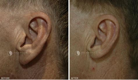 Its All About The Details Earlobe Reduction Surgery Is Popular With Both Male And Female