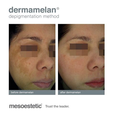 Cosmelan Dermamelan Skin Hair