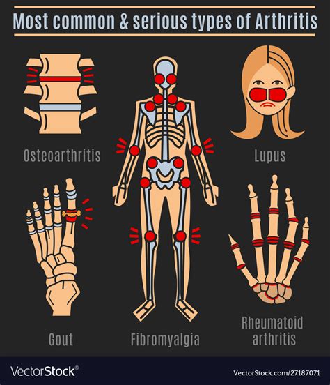 Arthritis types infographic Royalty Free Vector Image