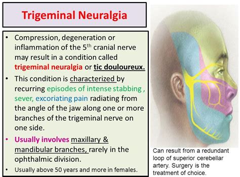 Trigeminal Neuralgia Signs And Symptoms
