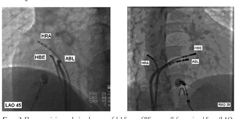 Figure From Successful Radiofrequency Catheter Ablation Of The Para