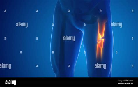broken leg femur bone pain medical concept stock photo alamy