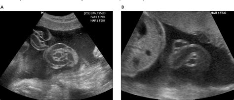 Figure 1 From Three Dimensional Power Doppler Sonography In The