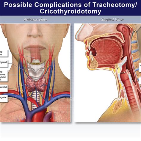 Possible Complications of Tracheotomy/ Cricothyroidotomy ...