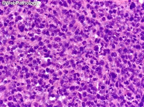 Embryonal Rhabdomyosarcoma Paratesticular