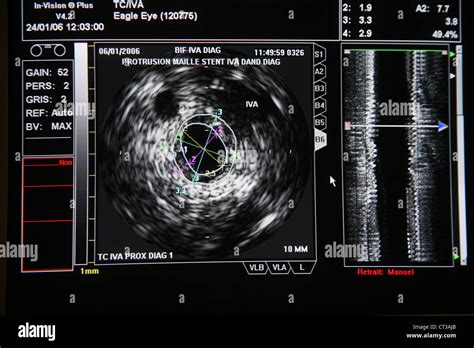 ENDOVASCULAR ULTRASOUND RESULT Stock Photo - Alamy